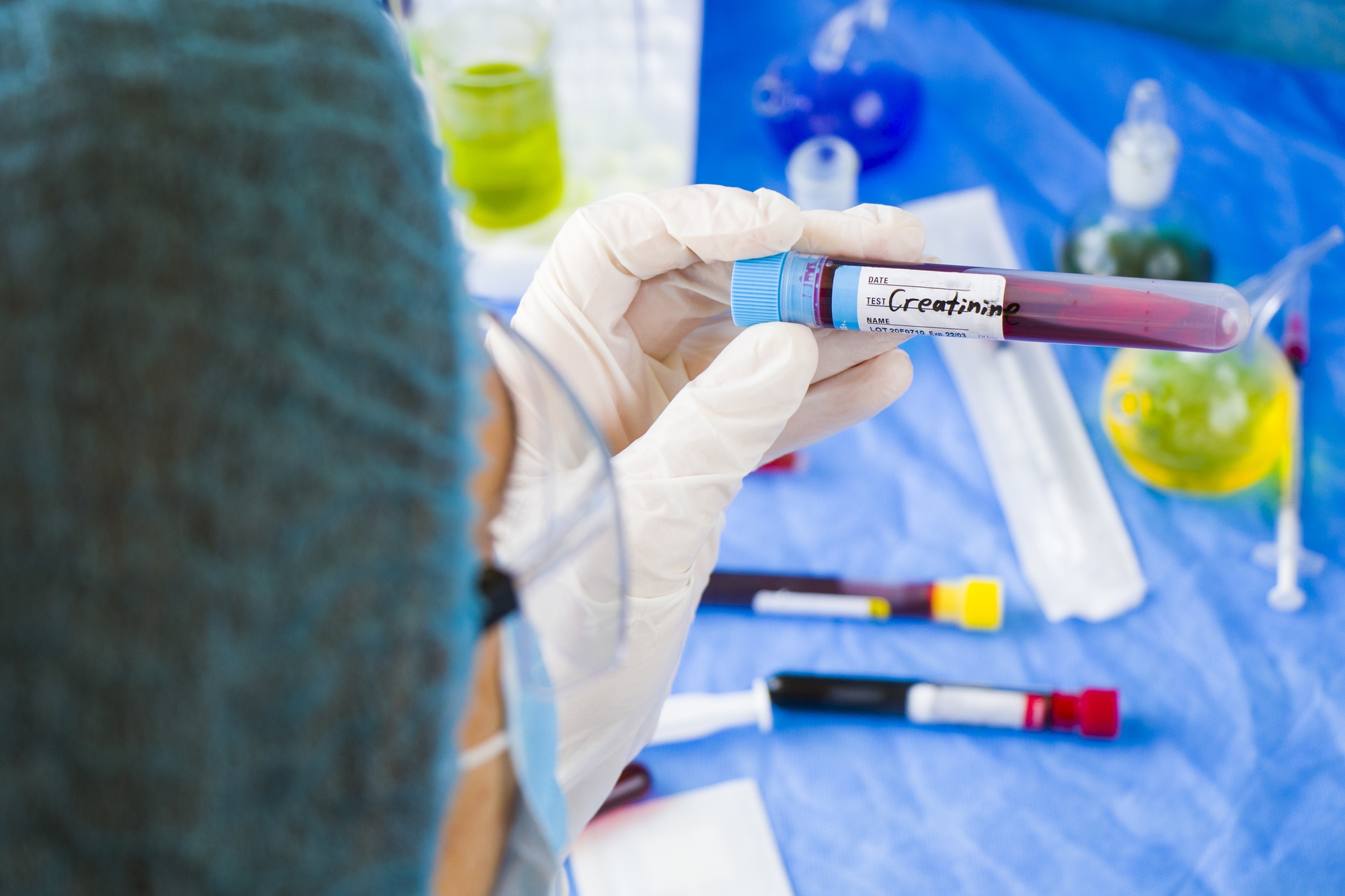 Doctor holding a creatinine blood test tube sample in a laboratory