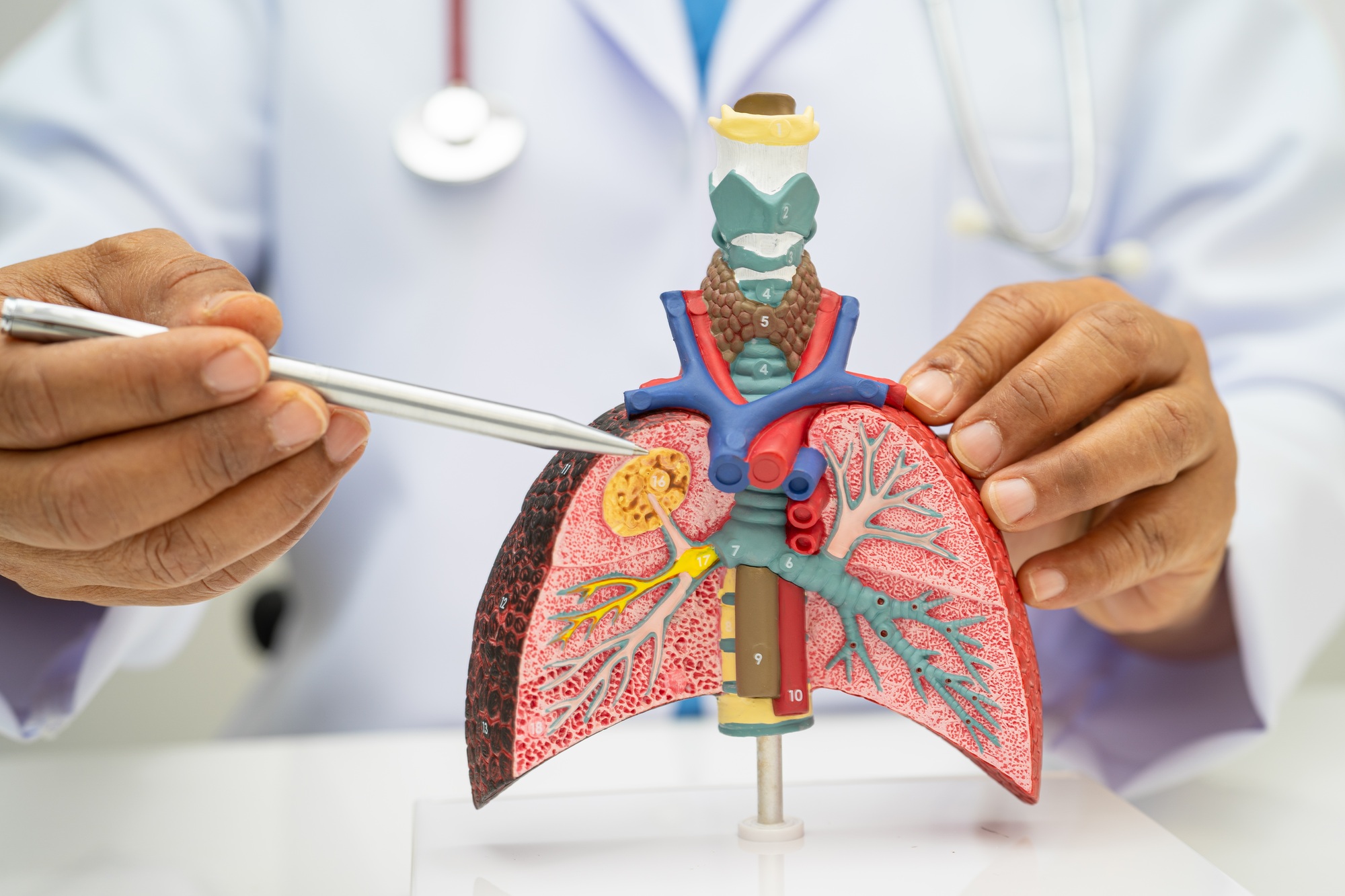 Pneumonia, lung cancer, Asian doctor holding human anatomy model for study diagnosis